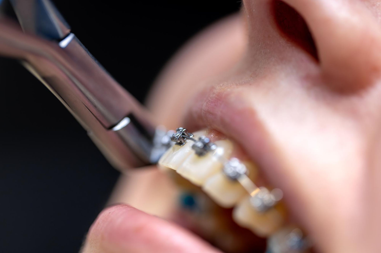 Combining Orthodontics and Veneers: A Powerful Smile Transformation